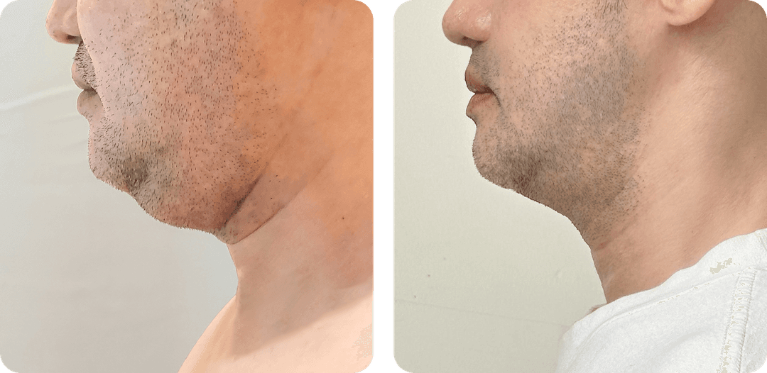 8 months after LAMS