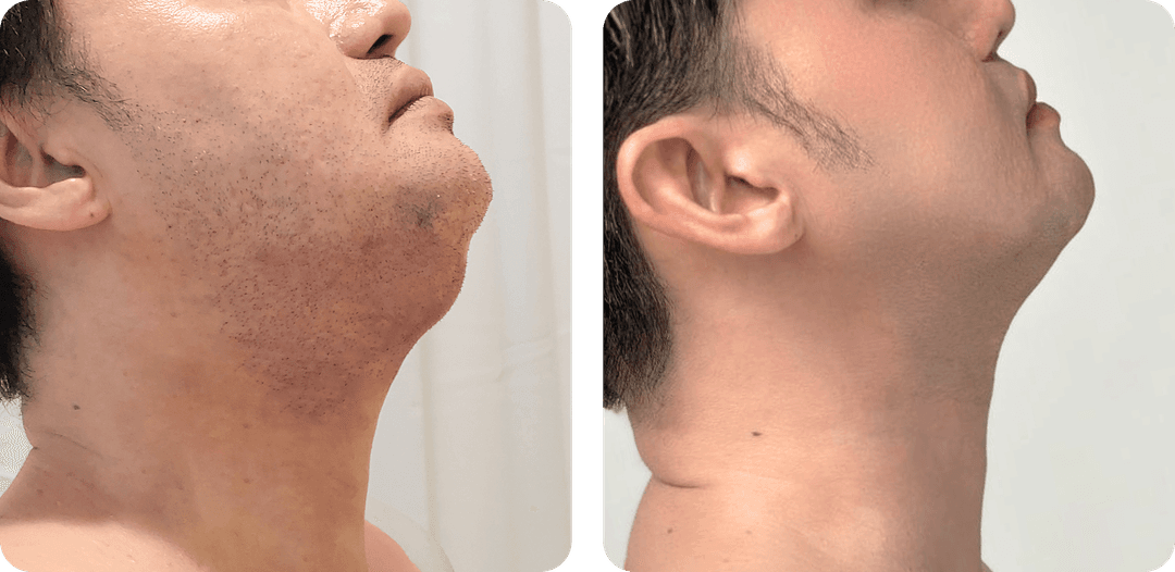 8 months after LAMS