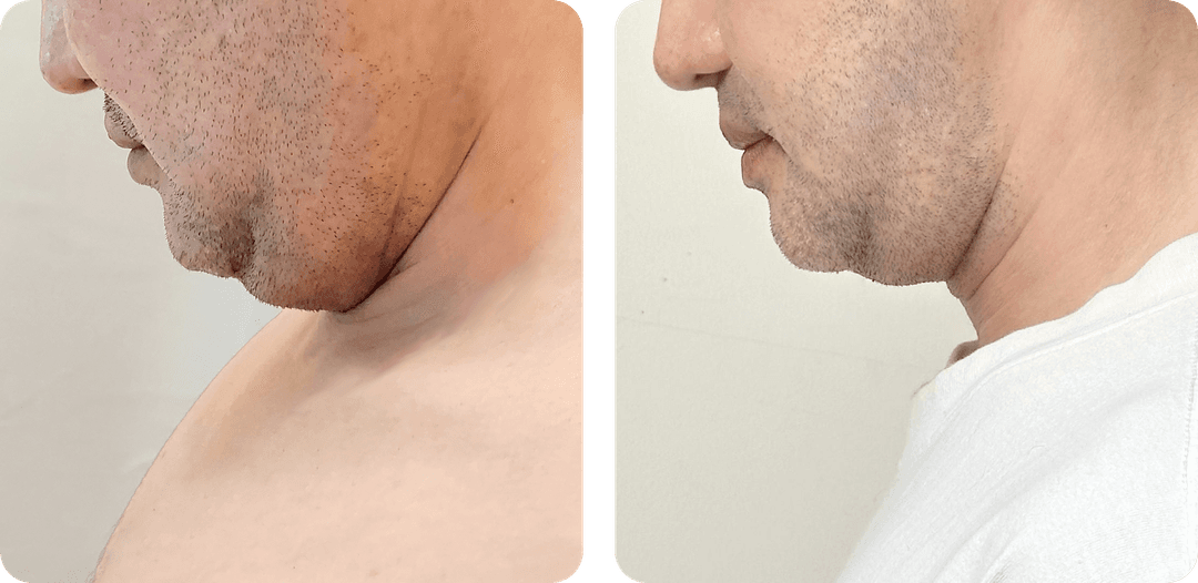 8 months after LAMS