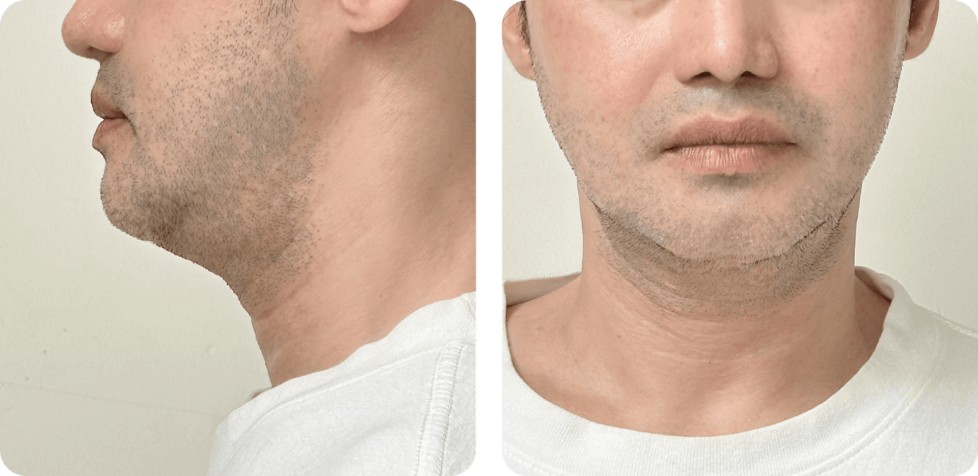 8 months after LAMS